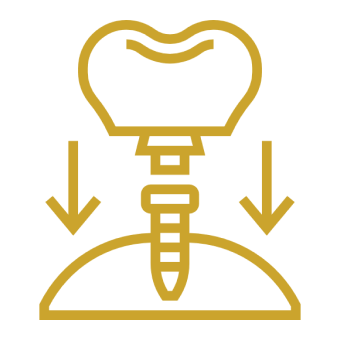 Dental Implant Placement